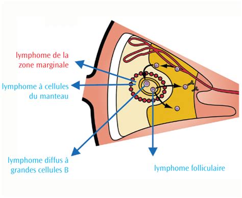 Schéma des différents types de lymphomes de la zone marginale