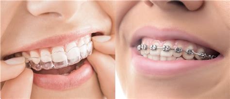 Comparaison des appareils orthodontiques : bagues vs gouttières