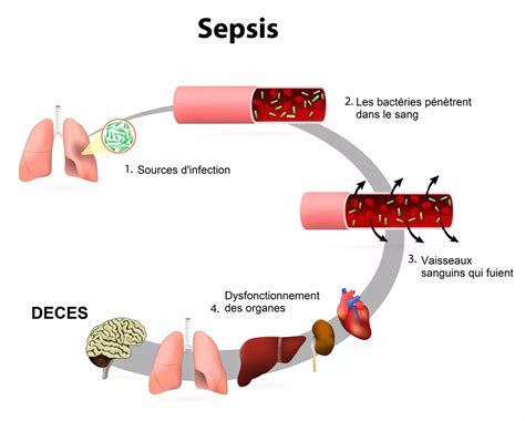 Schéma comparatif des termes : septicémie, sepsis et choc septique
