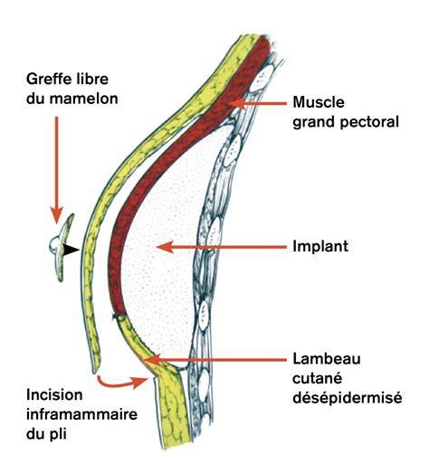 Schéma illustrant une mastectomie et une reconstruction mammaire