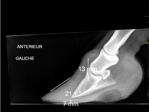 Radiographie montrant le basculement de la troisième phalange
