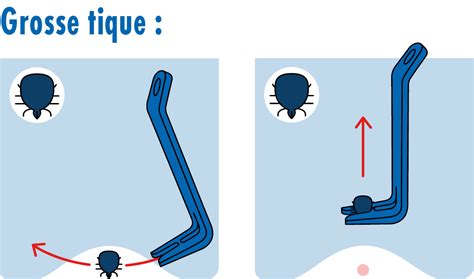 Illustration montrant comment retirer correctement une tique avec une pince.