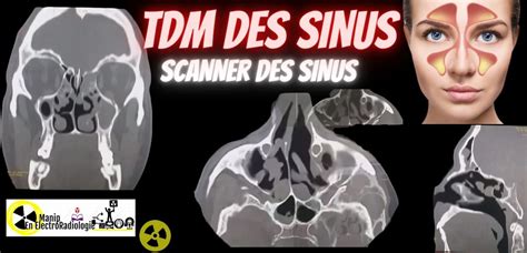 Image de TDM d'un sinus équin