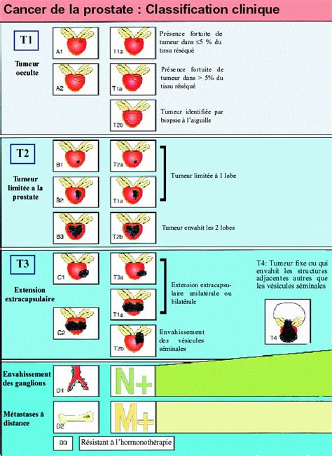 Diagramme illustrant les différents stades TNM du cancer de la prostate