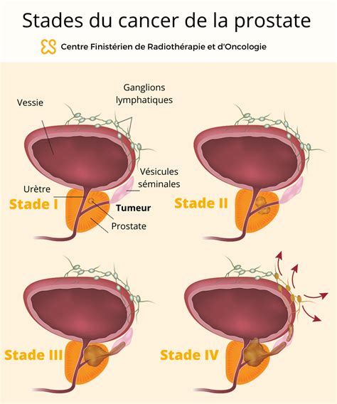 Infographie résumant les différents stades du cancer de la prostate et leurs implications pronostiques