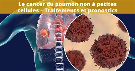 Diagramme comparant le cancer du poumon à petites cellules et non à petites cellules