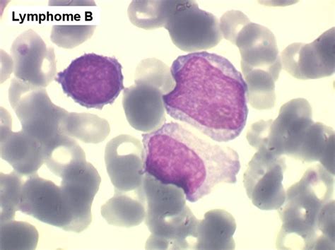 Illustrations de lymphocytes B normaux et de cellules de lymphome B diffus à grandes cellules