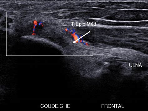 Échographie d'un tendon équin présentant une lésion