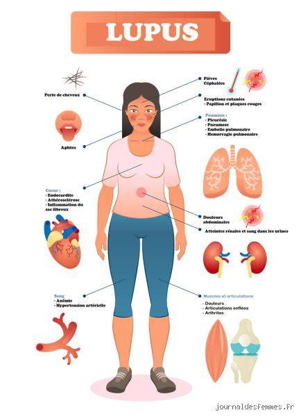 Schéma illustrant les différents organes touchés par le lupus érythémateux systémique