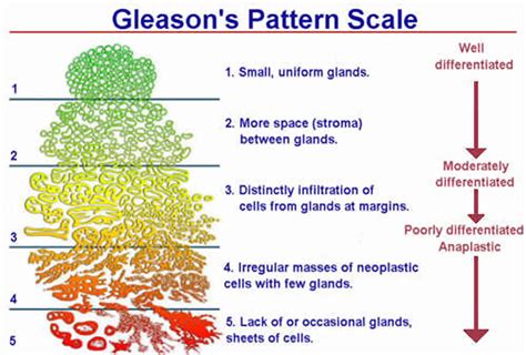 Schéma explicatif du score de Gleason