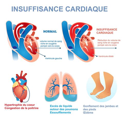 Diagramme illustrant les liens entre insuffisance cardiaque et facteurs de risque de cancer