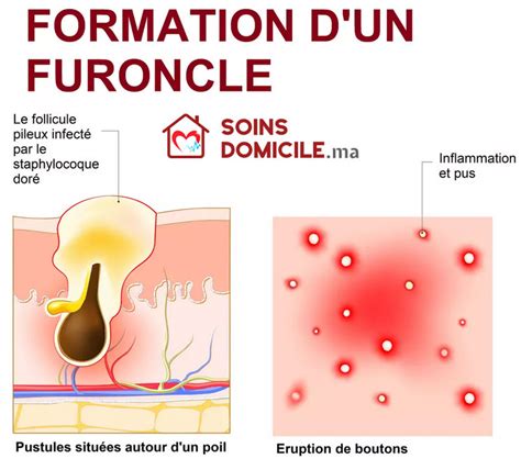 Illustration d'un furoncle à différents stades d'évolution