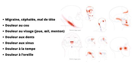 Illustration d'une personne ayant des douleurs à la mâchoire et au cou