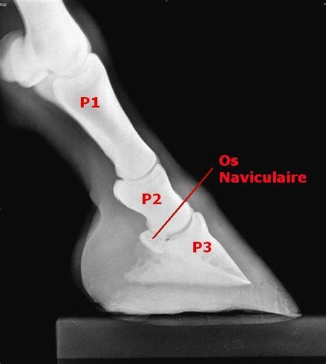 Radiographie de sabot de cheval montrant la rotation de la troisième phalange