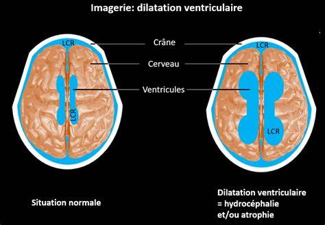 Image IRM d'un chien montrant une dilatation ventriculaire caractéristique de l'hydrocéphalie